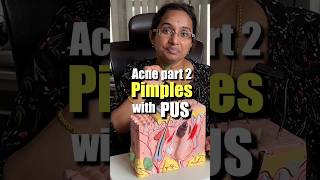 How To Treat Pus Filled Acne At Home  Papules amp Pustules trending [upl. by Keele]