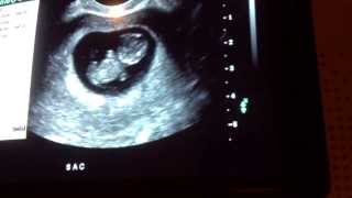 9 weeks 6 days ultrasound  baby moves [upl. by Aceber]