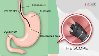 Preparing For Your Gastroscopy OGD  GUTCARE [upl. by Nytsirc112]