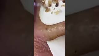 cravos pretos no rosto escreva se no canal limpezaprofunda espinhas acne limpeza compartilhe [upl. by Teuton]