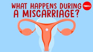 What happens in your body during a miscarriage  Nassim Assefi and Emily M Godfrey [upl. by Etnasa965]