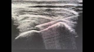 Ultrasound guided supraspinatus tendon injection [upl. by Tati]