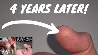 4 Years Later after slicing my finger open [upl. by Tenneb]