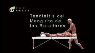 I➨ Tendinitis del Manguito de los Rotadores [upl. by Anal]