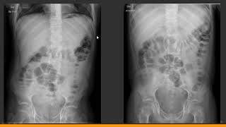 Anatomía Radiológica del Abdomen  1a parte [upl. by Onavlis]