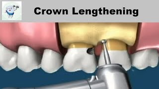 Crown Lengthening Procedure Animation [upl. by Hooge]