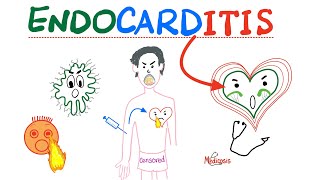 Infective Endocarditis  Fever amp New Murmur  Modified Duke’s Criteria  Cardiology Playlist [upl. by Hannej569]