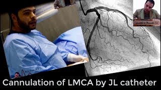 Left coronary system angiographic cannulation by JL catheterDr Alaa Nasr2019 [upl. by Demetra]