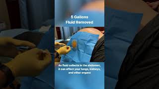 5 Gallons Drained From Abdomen  40lbs of Fluid shorts [upl. by Lebazi961]