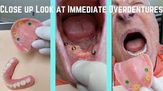 Close up look at upper and lower immediate snapin overdentures [upl. by Enimajneb]