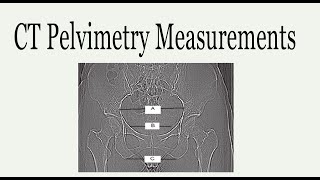 CT Pelvimetry Measurements [upl. by Diamante]