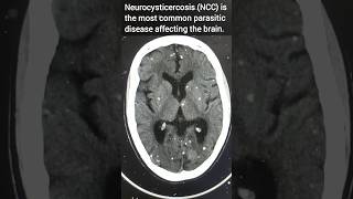 Neurocysticercosis l NCC l Stary ⭐ appearance in the brain neuroradiology radiology shorts [upl. by Calmas]