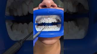 InOffice Teeth Whitening Process 🫶🏻 [upl. by Ettener]