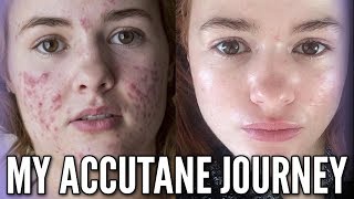 My Accutane Journey with Progress Photos and Relapse Experience [upl. by Feledy154]