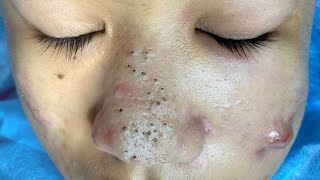 Big Cystic Acne Blackheads Extraction Blackheads amp Milia Whiteheads Removal Pimple Popping  2997 [upl. by Azarcon]