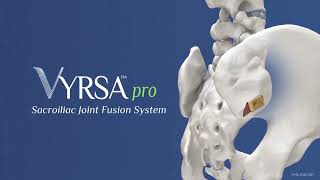 True Arthrodesis with the VYRSApro SI Fusion System [upl. by Culliton]