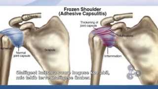 HOW TO FIX FROZEN SHOULDER TV SHOW ADHESIVE CAPSULITIS CURE TRIGENICS quotOATquot PROCEDURE [upl. by Anaihr726]