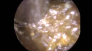 276  Ear Wax Removal with Jobson Horne and Suction revealing MIDDLE EAR EFFUSION [upl. by Ilene691]