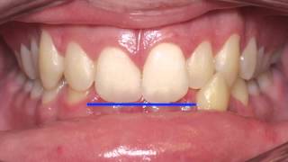 Anterior Crossbite Correction Kyger Orthodontics [upl. by Hairahs654]