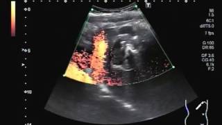 Ultrasound Video showing Hydatid Cyst in the Liver mimicking a solid mass [upl. by Oirevlis]