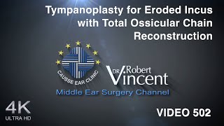 Tympanoplasty for Eroded Incus with Total Ossicular Chain Reconstruction [upl. by Ailimac]