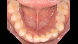 Aggressive periodontitis [upl. by Tnomal552]