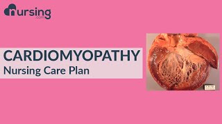 Nursing Care Plan for Cardiomyopathy Nursing Care Plan Tutorial [upl. by Marzi]