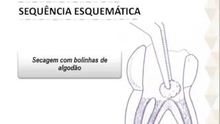 Protocolo Terapia Pulpar com Pasta CTZ [upl. by Adnawak]