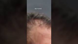 I Tried The FasciaBlaster  Hair Before and After [upl. by Annyrb]