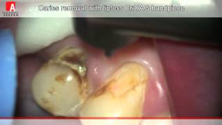 CARIES REMOVAL Fotona Lightwalker ErYAG laser [upl. by Einnaf]