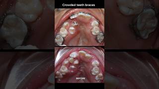 The most crowded teeth ive ever seen braces orthodontist dentist [upl. by Otsenre]