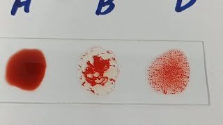 how to perform blood groupblood group ABO blood groupingB positive blood group [upl. by Yarezed]