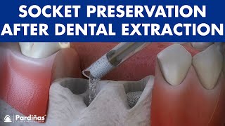 Tooth extraction  Treatment for socket preservation © [upl. by Anelet]