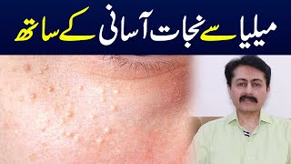 Milia causes symptoms and treatment  Dr Faisal Syed [upl. by Anovad7]