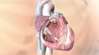 Dr Nghia Hoang amp Worlds Smallest Pacemaker [upl. by Nelsen]