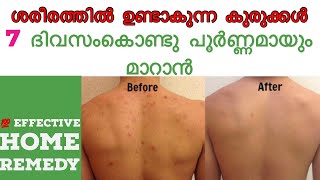 How To Get Rid of Back Acne the Natural Way  Effective Home Remediesmalayalam [upl. by Palila]