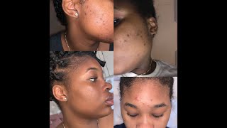 How I Cleared My Dark Spots amp Ingrown Hairs  IN DEPTH [upl. by Croom]