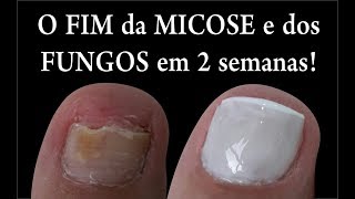 O FIM DAS MICOSES E FUNGOS NAS UNHAS EM 2 SEMANAS Feat Kátia Rosenberg por Joyce Vignochi [upl. by Macdonald]