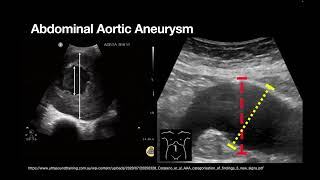 AAA and ABDO Emergencies [upl. by Barram]