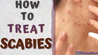 HOW TO TREAT SCABIESscabies treatment at home [upl. by Aileen]