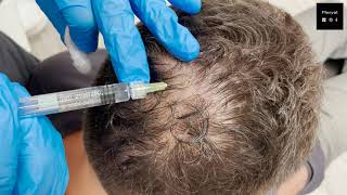 Hair loss Treatment with Pluryal Hair density [upl. by Gnuy]