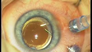 101 Removal of posterior capsular opacification and a very unusual fundus [upl. by Brinn]