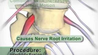 Anterior Lumbar Interbody Fusion [upl. by Eenahpets]