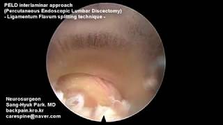 PELD interlaminar approach PEID LF splitting technique [upl. by Onej447]