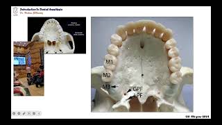 02 maxillary palatal infiltration anesthetic technique [upl. by Rusty13]