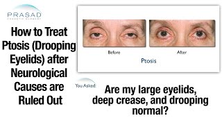 Rule Out Neurological Causes of Drooping Eyelids before Ptosis Correction Surgery [upl. by Nolitta]