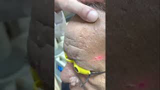 Sebaceous hyperplasia laser removal [upl. by Eynenihc]