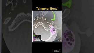 CT temporal Bone anatomy mastoid temporalbone [upl. by Rubi779]