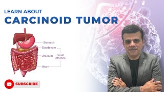 Understanding Carcinoid Tumors Insights from Lungs to Appendix  Dr Sashikant Adlekha [upl. by Amekahs592]