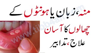 Treatment of mouth blisters  منہ، زبان یا ہونٹوں کے چھالوں کاآسان علاج [upl. by Ainesej]